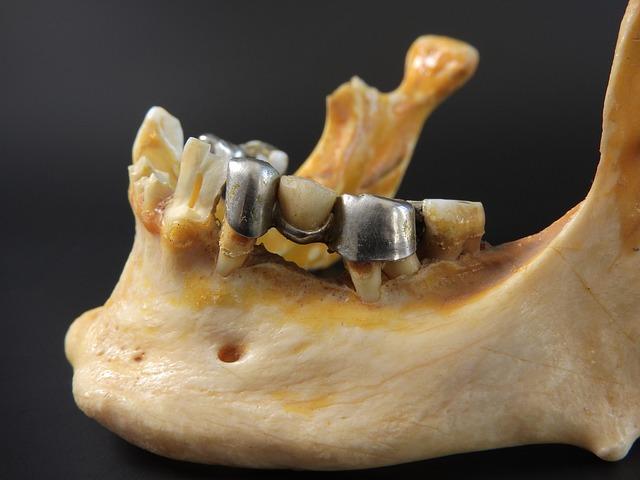 Jak funguje proces z&iacute;sk&aacute;n&iacute; zubn&iacute;ho můstku na implant&aacute;tech