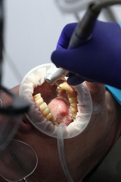 Bělení zubů dentální hygiena: Jak správně postupovat?